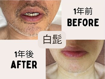 エムディーエス 新宿御苑(MDS)/白髪脱毛も◎