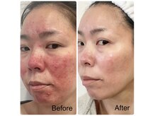 リオーラ(reola)の雰囲気（自身の深刻な肌荒れを7カ月でノーファンデ肌に改善）