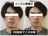 【メンズ小顔矯正】すっきり！フェイスライン改革★エラ張り改善　60分￥3500