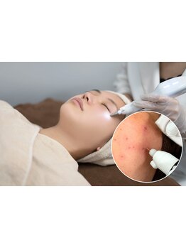 シミしわ改善！予防ケア