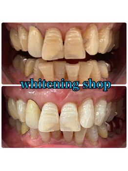 ホワイトニングショップ 日進店/Before After日進ホワイトニング