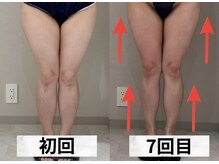 イヨヨ(iyoyo)/【痩身】Before After