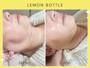 ハノハノ 八代店(HANO HANO)/【八代初導入!】レモンボトル☆