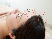 本厚木鍼灸整骨院の雰囲気（眼精疲労に効くお目元のお灸が人気♪デスクワークの方にオススメ）