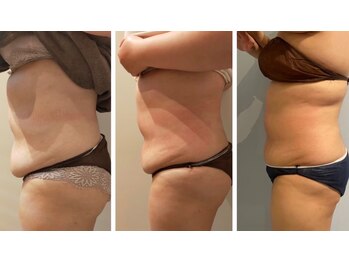 ルナグランデ(Luna grande.)/自信が持てるボディに