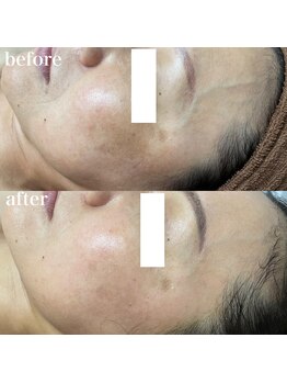 ナチュレ(Nature)/ハーブピーリングbefore→after