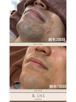 アンドユクス 中野(and uks)/メンズ/ひげ脱毛