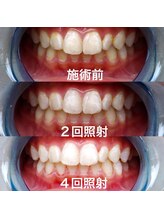 ティンクル(TWINKLE)/体験プレミアムホワイトニング