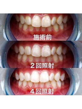 ティンクル(TWINKLE)/体験プレミアムホワイトニング