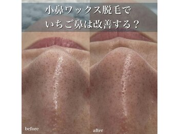 サニーヒルズ ウィズ マキア 藤沢(Sunny hills with MAQUIA)/小鼻ワックス脱毛