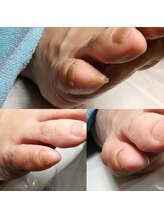 ドクターネイル爪革命 長野店/【肥厚・変形爪】ネイル/フット