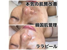 話題沸騰中の韓国肌管理ララピール！剥離なしダウンタイムなし◎