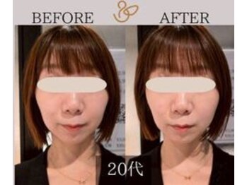 チョコバリ 新宿店(chocobari)/小顔×リフトアップ(美容鍼)20代