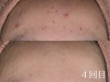 ホワイトアクア 中目黒店(WHITE AQUA)/ハーブピーリング/ニキビ/中目黒