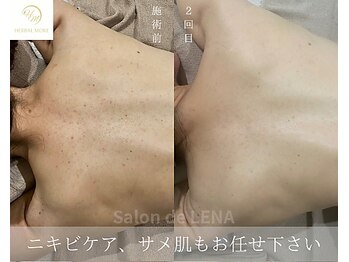 サロンドレナ 名駅店/ハーブピーリング サロンドレナ