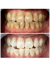 エンコロレ(encolore)/《クリスタルホワイトニング》