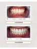 セルフホワイトニング3ヶ月以内（9回まで） ¥48,510→¥36,000