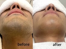 ブロンズ(Bronze)/ひげ脱毛　ビフォーアフター