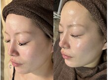 セルヴィノバ(CELL VI NOVA)/＊ビフォーアフター