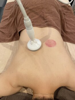 ハピネス(HappIness)/カッピング(6か所)