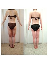 エステティック ブランシュール(Blancheur)/術後ケア（大腿部全周吸引後）