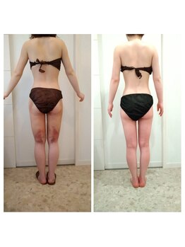 エステティック ブランシュール(Blancheur)/術後ケア（大腿部全周吸引後）