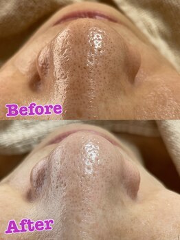 サンテ(Sante)/ハイドラフェイシャル×光フォト