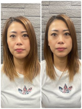 長寿鍼灸院 長寿整骨院/左右非対称のお顔に美容鍼★50本