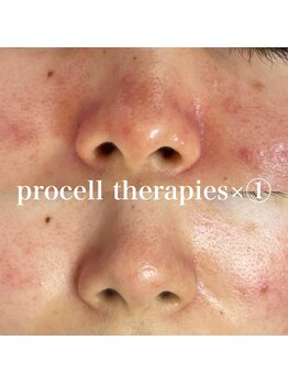 ティンクルホワイト 橿原店/最強の肌質改善にはプロセル