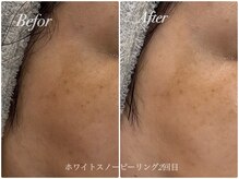 エミー(emy)/江坂/毛穴/ハーブピーリング