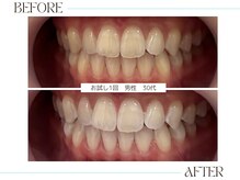 ホワイトニングサロンブライト 尼崎店(Whitening salon bright)/すぐに効果実感！！！
