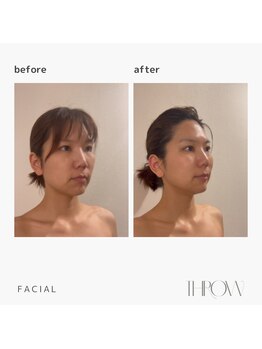 スロウ(THROW)/インディバ　整顔小顔矯正