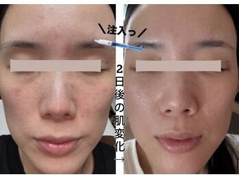 エバーグリーン(Evergreen)/ハーブピーリング×ヒト幹注入