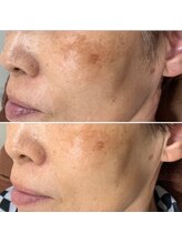 ラダ(RADA)/ハーブピーリング/シミ/ニキビ