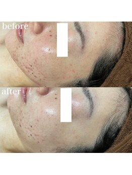 ナチュレ(Nature)/ハーブピーリングbefore→after