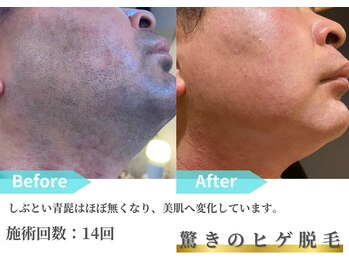 トレース/ヒゲ脱毛の効果