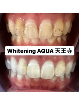 アクア 天王寺店(AQUA)/セルフホワイトニング/天王寺