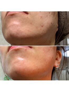 美肌研究所 東京新宿支店/フェイスラインがつるつるに