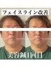 【これでモテ男】メンズ美容鍼 80分￥11,000→5,000