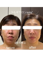 ソラ(sola*)/二重顎撃退