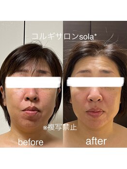 ソラ(sola*)/二重顎撃退