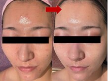 ブリリアン デイスパ 阪急西宮ガーデンズ店(BRILLIAN DAYSPA)/水光ピーリング