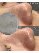 ベイビースキン(Baby skin)/tete式 毛穴エクストラクション