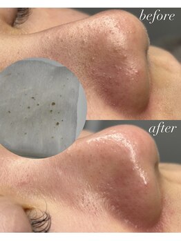 ベイビースキン(Baby skin)/tete式 毛穴エクストラクション