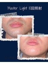 レオナルド(Leonardo)/ヒゲ照射4回