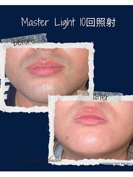 レオナルド(Leonardo)/ヒゲ照射4回