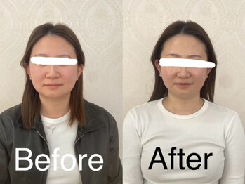 キヨカ(kiyoka)/小顔フェイシャルBefore・After