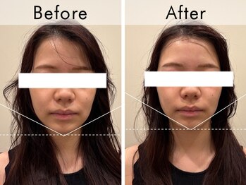 ハリラウンジ 梅田店(Hari Lounge)/美容鍼専門サロン Hari Lounge