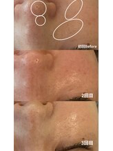 ニコ(nico)/鼻の目立った毛穴、諦めないで！