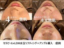 ルミエ 恵比寿店(Lumie)/セラピール&LDM水玉リフティング